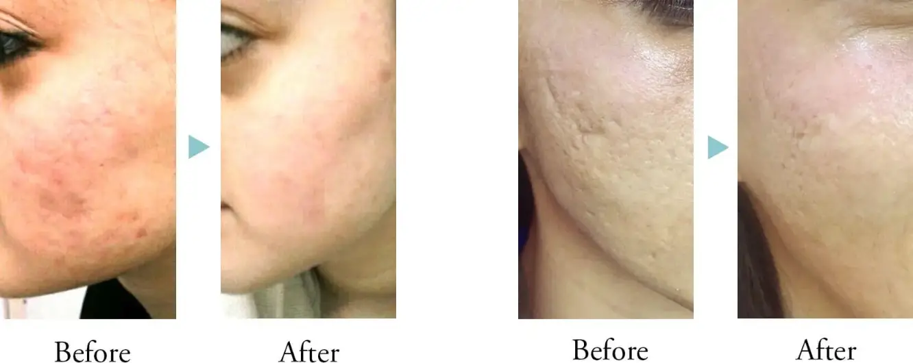 BEAUTY SKIN CLINIC（ビューティースキンクリニック） ヴェルヴェットスキン