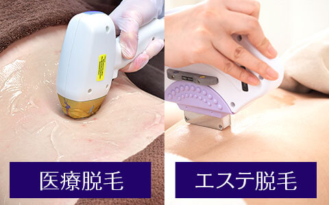 （２）医療脱毛とエステ脱毛を比較【医療脱毛のメリットを詳しく解説】