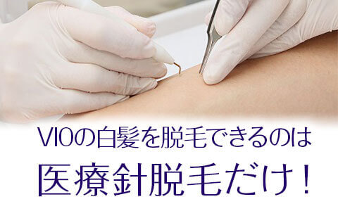 白髪の脱毛ができるのは医療ニードル（針）脱毛だけ