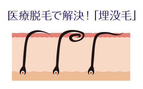 医療脱毛で解決 埋没毛が出来る原因と対策