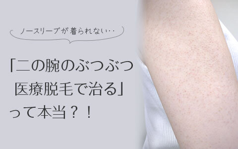 二の腕のぶつぶつの原因と治し方！皮膚科の医療脱毛で治ったって本当？