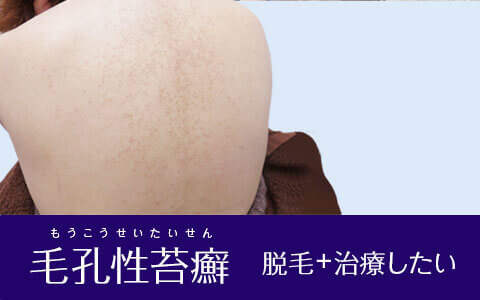 毛孔性苔癬があっても脱毛できる？一緒に治療もできる？